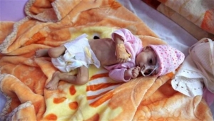الصحة العالمية: 17.8 مليون شخص بحاجة إلى مساعدات صحية نصفهم أطفال في اليمن
