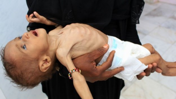 منظمات أممية: ارتفاع حاد في سوء التغذية لدى الأطفال باليمن