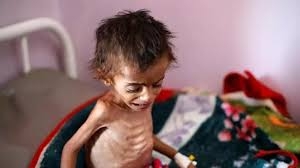 كورونا يفاقم المجاعة وسوء التغذية في اليمن