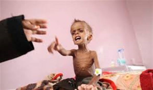 يونسيف : سوء التغذية يهدد 400 ألف طفل يمني