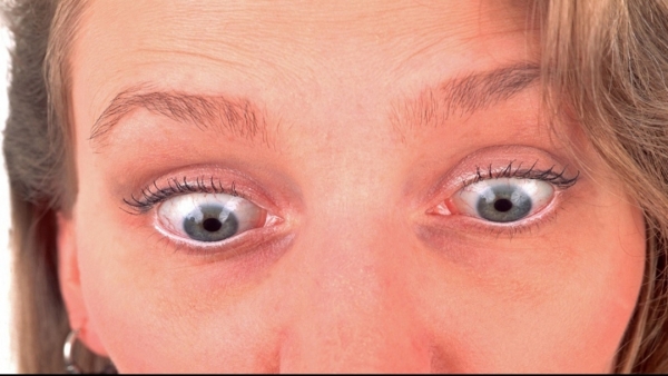 ما أسباب ظهور الدوائر الزرقاء تحت العينين؟