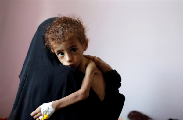 أطفال اليمن يتضورون جوعا والأمم المتحدة تطلب مليارات لتفادي مجاعة واسعة