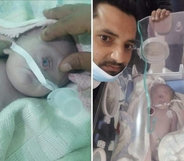 وفاة طفل بعد ساعات من ولادته بعين واحدة في محافظة البيضاء
